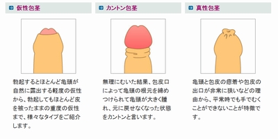 上野クリニック東京・新宿医院での包茎手術体験談B